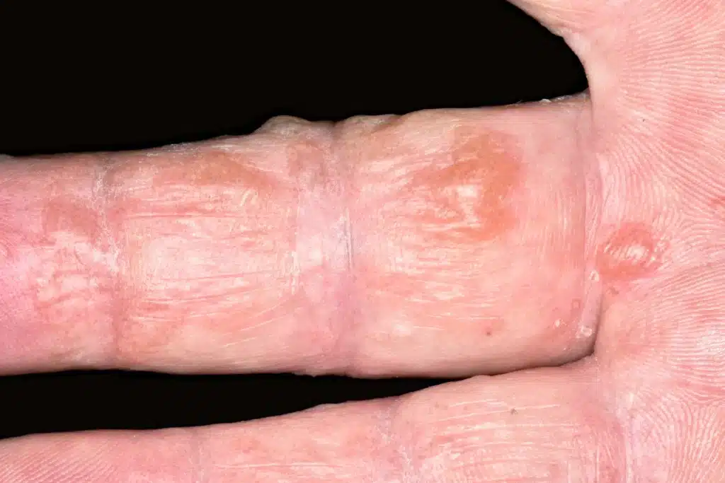 Dyshidrotic eczema blisters on fingers (close-up)