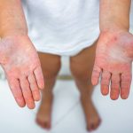 Dyshidrotic eczema on hands, Understanding Dyshidrotic Eczema, Dyshidrotic Eczema: Feet and Hands