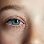 best cream foe eyelid eczema, eyelid dermatitis remedy, Best Treatments for Eyelid Dermatitis, Eyelid Dermatitis vs Eczema