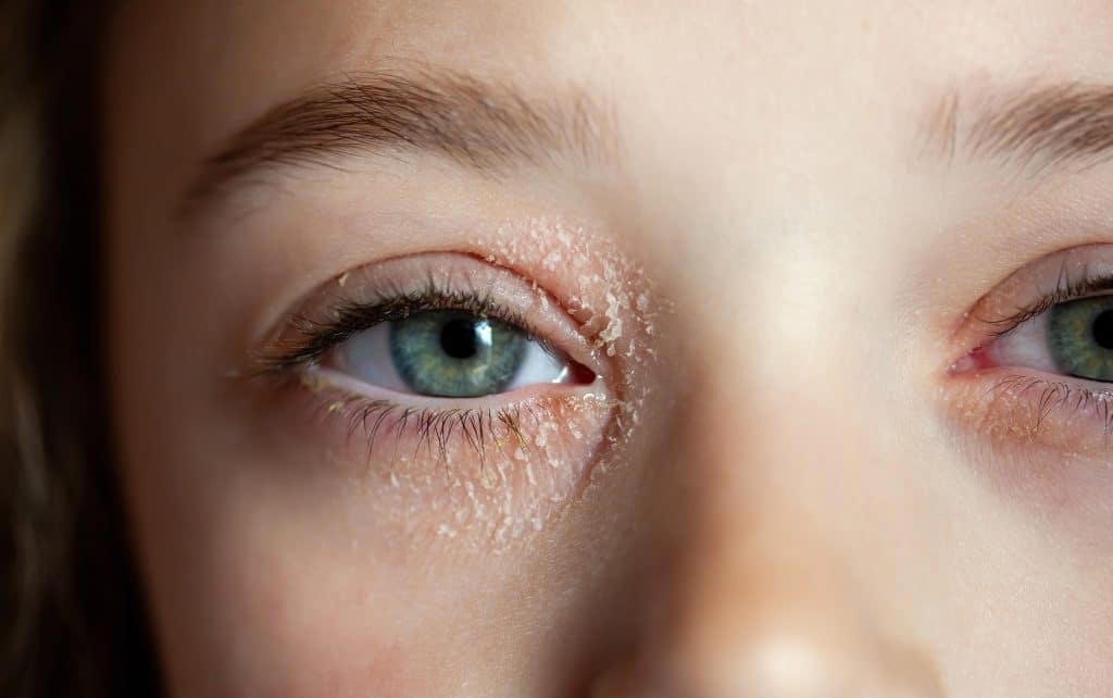 eyelid eczema, symptoms of eyelid eczema, treatment for eyelid eczema, causes of eyelid eczema, eyelid eczema cream, how to treat eyelid dermatitis,