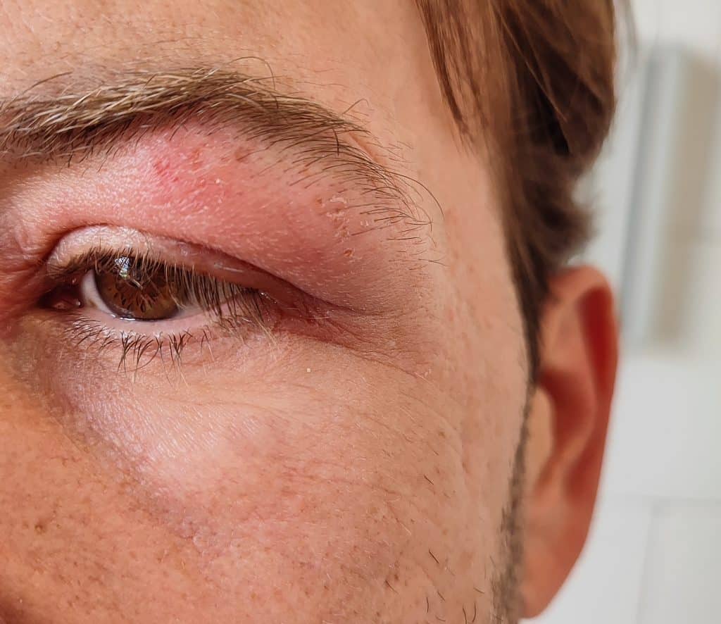 ​eyelid dermatitis, symptoms of eyelid dermatitis, treatment for eyelid dermatitis, causes of eyelid dermatitis, eyelid dermatitis in Ireland, eyelid dermatitis, EYELID AND FACE ECZEMA cream, eczema on eyelids,