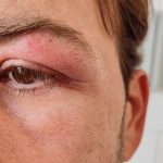 eczema cream, eyelid dermatitis, EYELID AND FACE ECZEMA cream, eczema on eyelids,