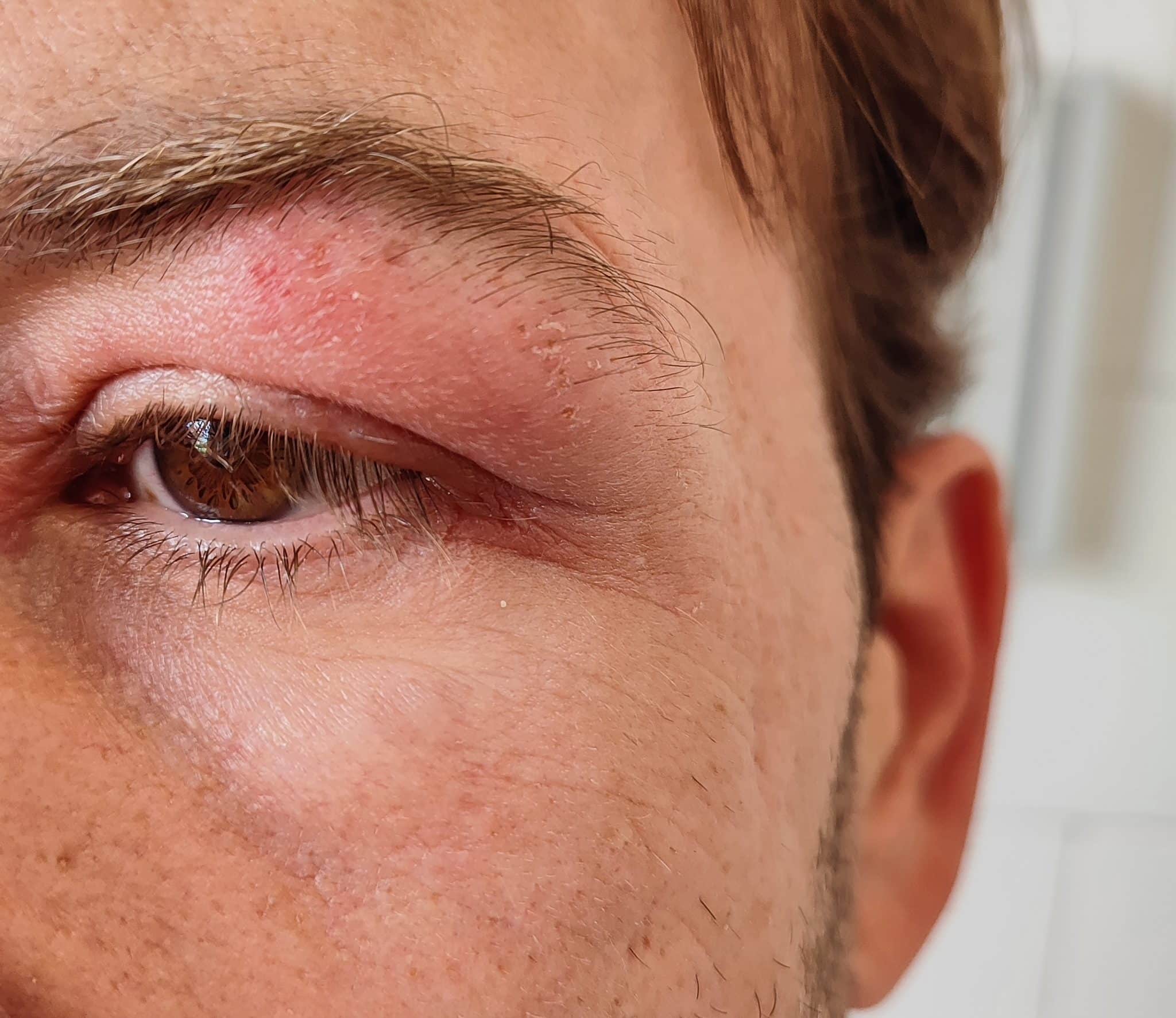 eczema cream, eyelid dermatitis, EYELID AND FACE ECZEMA cream, eczema on eyelids,