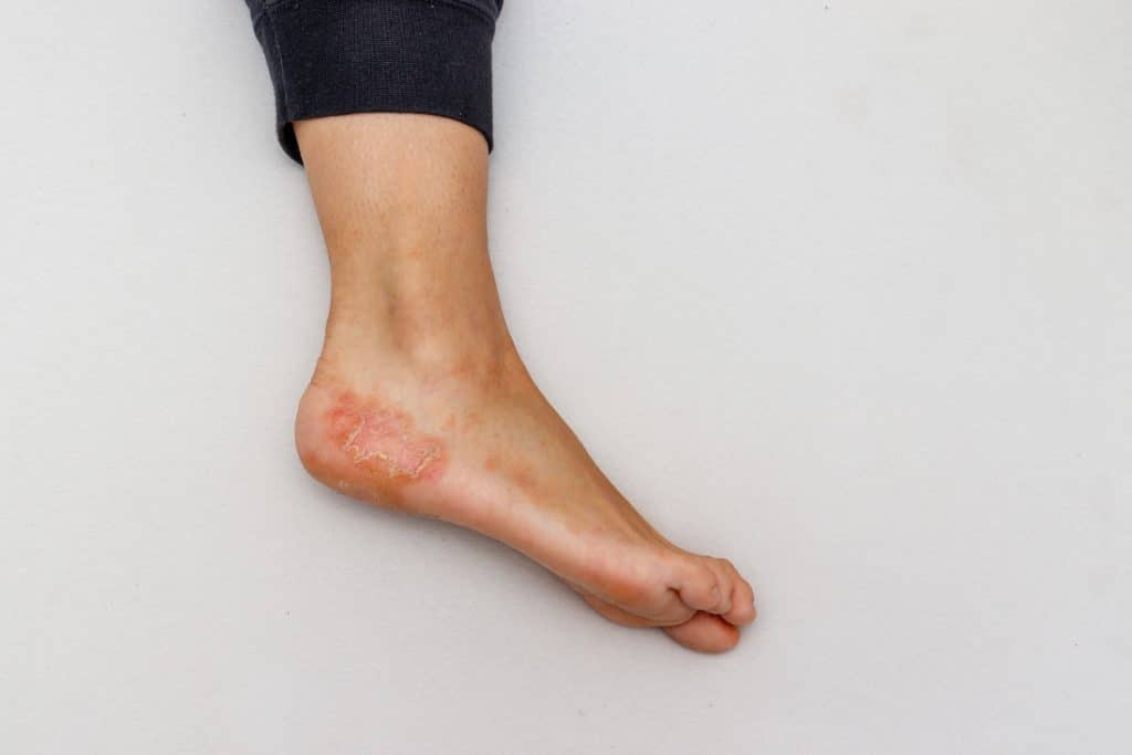 ​Dyshidrotic Eczema treatment, skin care for dyshidrotic eczema, dyshidrotic eczema natural remedies, best creams for dyshidrotic eczema, dyshidrotic eczema triggers