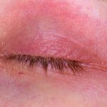 eyelid eczema, eyelid dermatitis, eyelid rash, dry eyelids, irritated eyelids,