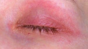 ​eyelid eczema, eyelid dermatitis, eyelid rash, dry eyelids, irritated eyelids,