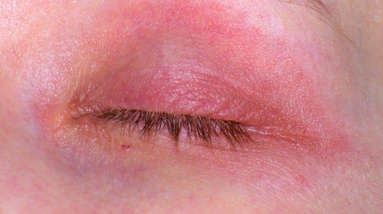 ​eyelid eczema, eyelid dermatitis, eyelid rash, dry eyelids, irritated eyelids,