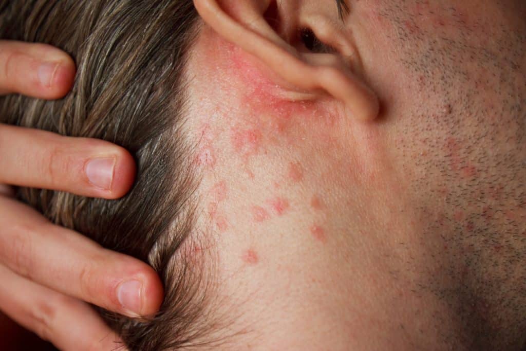 ​Eczema Behind Ears, itchy skin behind ears, eczema treatment Ireland, dry skin behind ears, soothing eczema rash, eczema relief tips, ​eczema behind ears, eczema treatment Ireland, itchy ears eczema, causes of eczema behind ears, eczema remedies for sensitive skin
