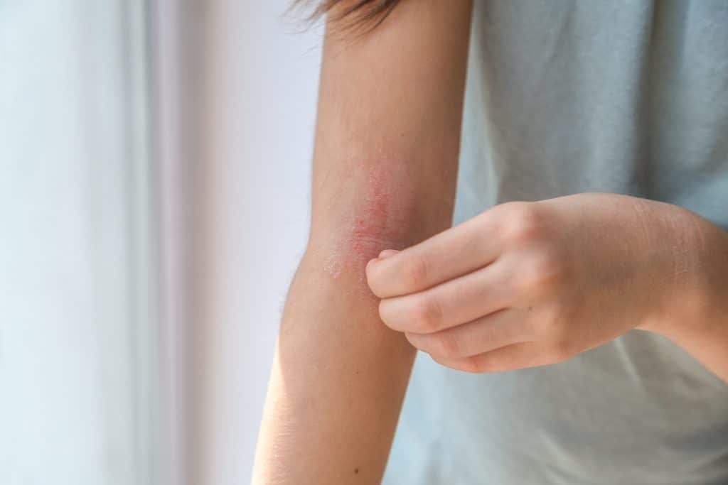 ​eczema treatment, natural eczema remedies, best creams for eczema, eczema treatment options, eczema relief products