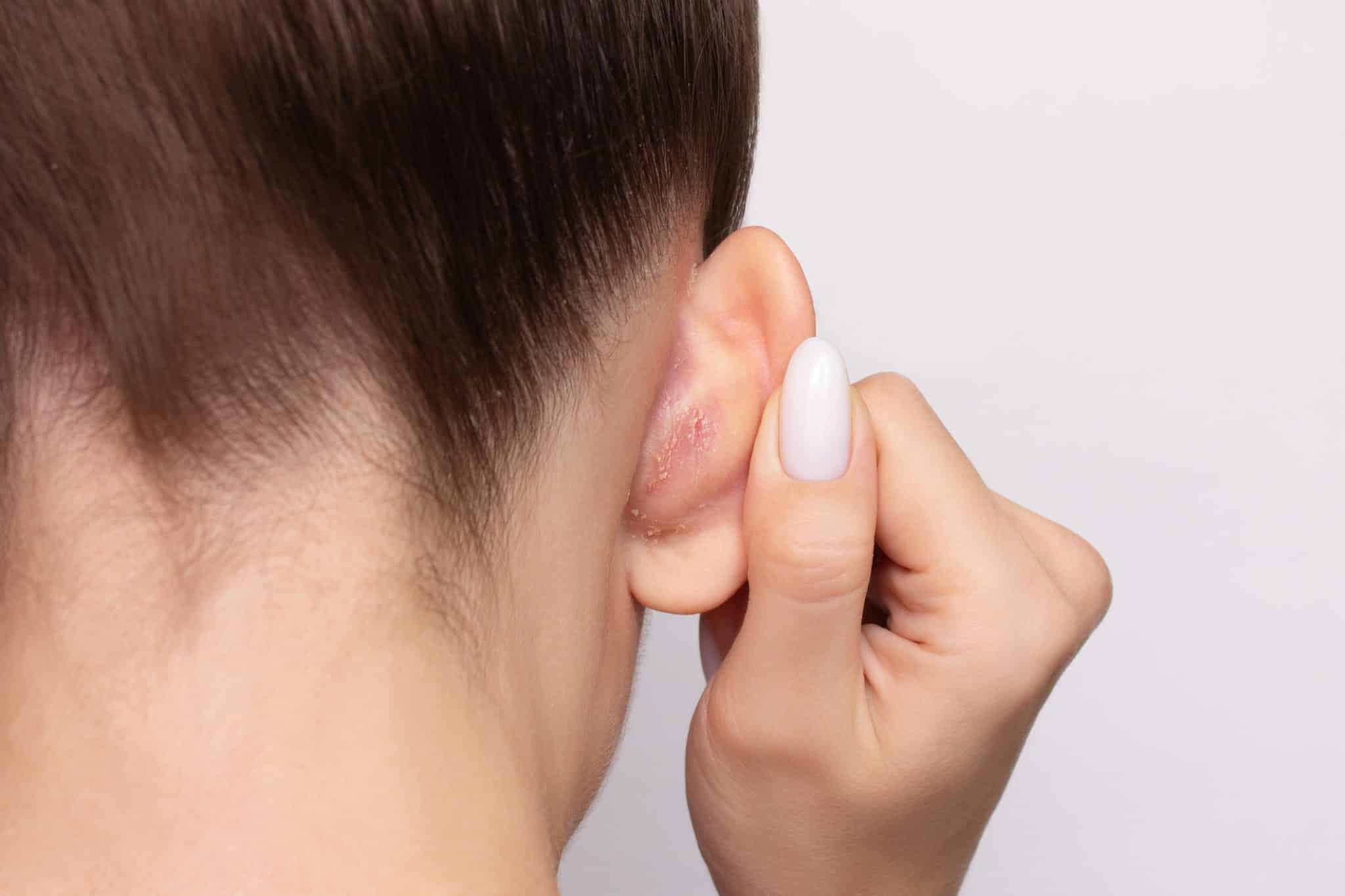 ​cream for eczema itching, eczema cream for sensitive skin, best cream for itchy eczema, natural treatment for eczema, soothing cream for eczema relief