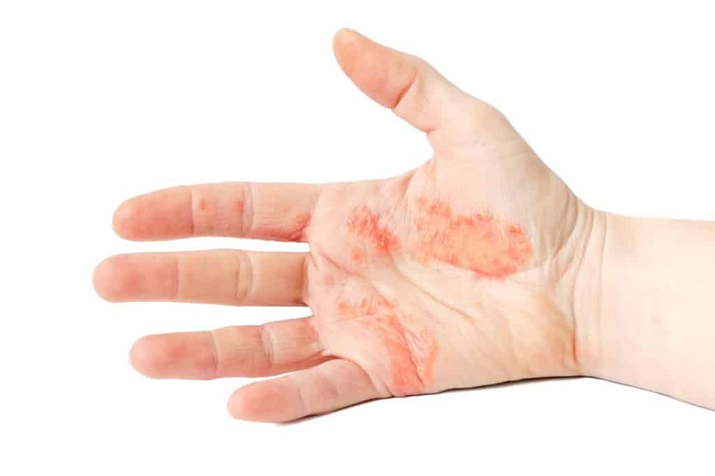 ​Dyshidrotic Eczema, itchy blisters, hand eczema, skin rash, eczema treatment