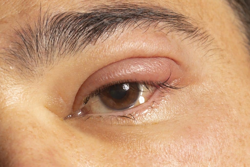 best eye cream for eczema on eyelids,eyelid eczema, symptoms of eyelid eczema, treatment for eyelid eczema, causes of eyelid eczema, eyelid eczema cream, Relief for Eczema on Eyelid