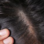 Scalp Treatment for Dry Scalp, sebhorrheic shampoo