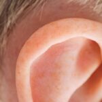 mild redness and irritation behind ear, itching behind ears symptom