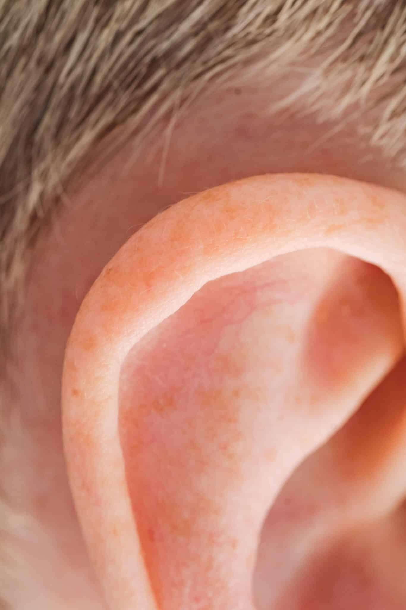 mild redness and irritation behind ear, itching behind ears symptom