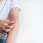 Contact Dermatitis Rash