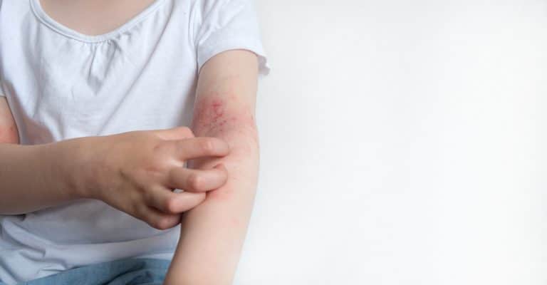 Contact Dermatitis Rash