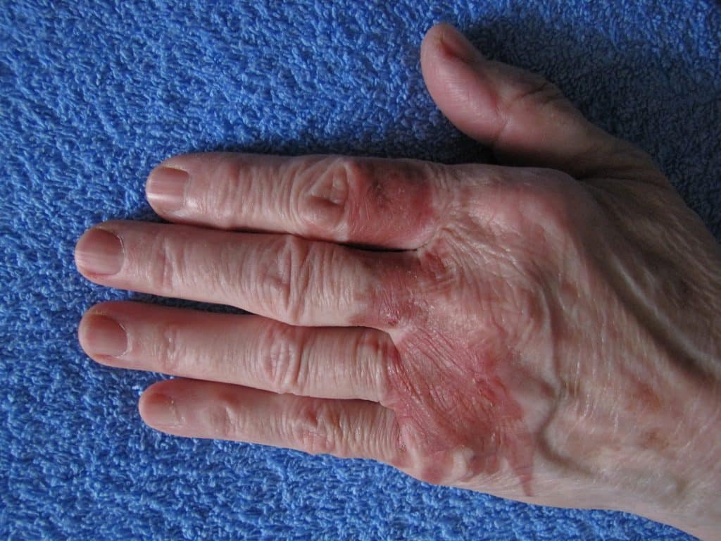 dermatitis on fingers,