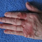 dermatitis on fingers,