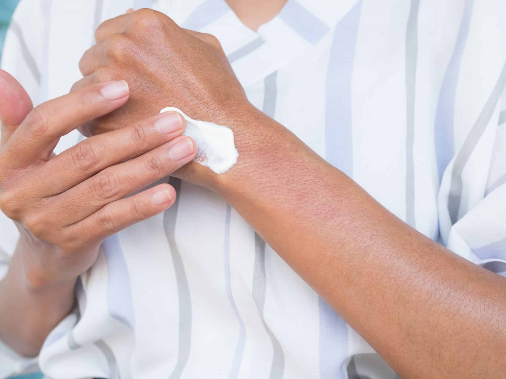 Elbow with eczema — applying moisturiser