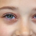 ​eyelid eczema, eyelid dermatitis, eye eczema treatment, itchy eyelids, eyelid rash causes, what is eyelid eczema, Eyelid Eczema Treatment at Home