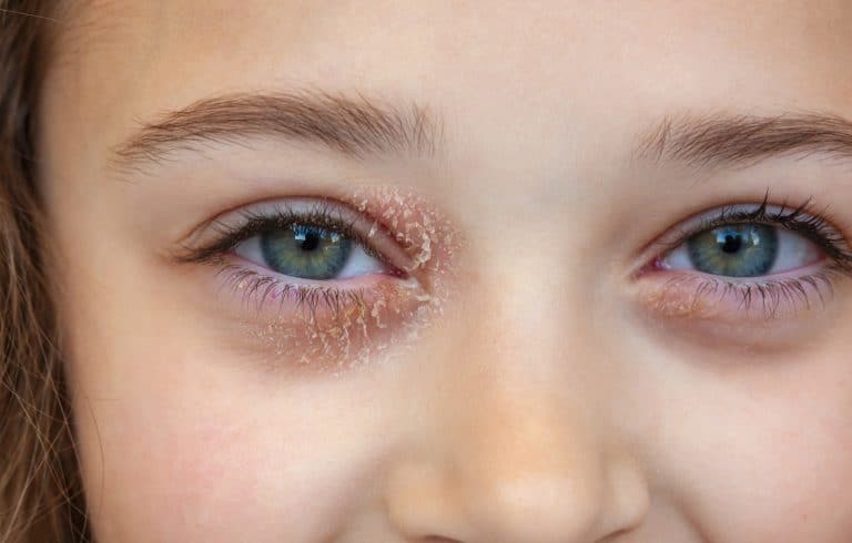 ​eyelid eczema, eyelid dermatitis, eye eczema treatment, itchy eyelids, eyelid rash causes, what is eyelid eczema, Eyelid Eczema Treatment at Home