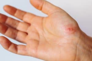cream for warts,