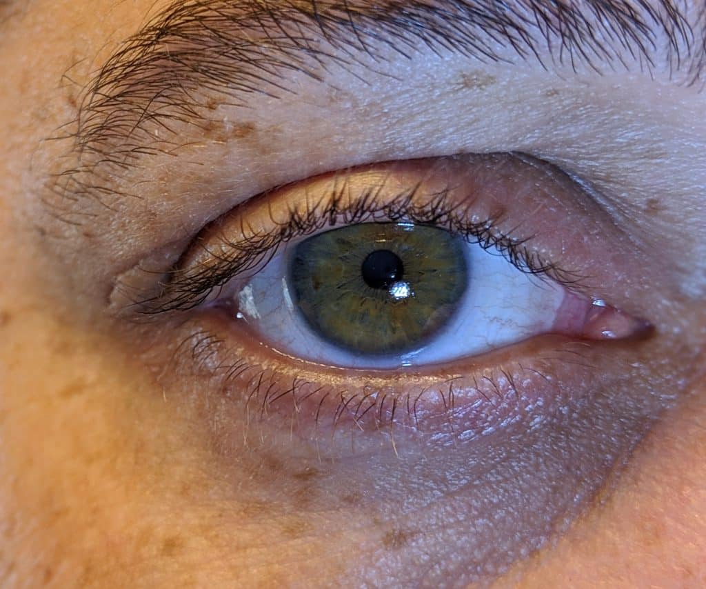 best eye cream for eczema on eyelids, ​eyelid eczema, eyelid dermatitis, eyelid rash, dry eyelids, irritated eyelids