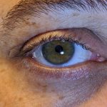 eyelid eczema, eyelid dermatitis, eyelid rash, dry eyelids, irritated eyelids