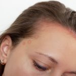 seborrheic dermatitis shampoo, scalp healer, scalp treatment, hair scalp care, itchy scalp relief, scalp repair cream, sebhorrheic dermatitis treatment, scalp care, antifungal shampoos, moisturizing creams, skin care routines, natural remedies, Shampoo for Scalp Psoriasis,