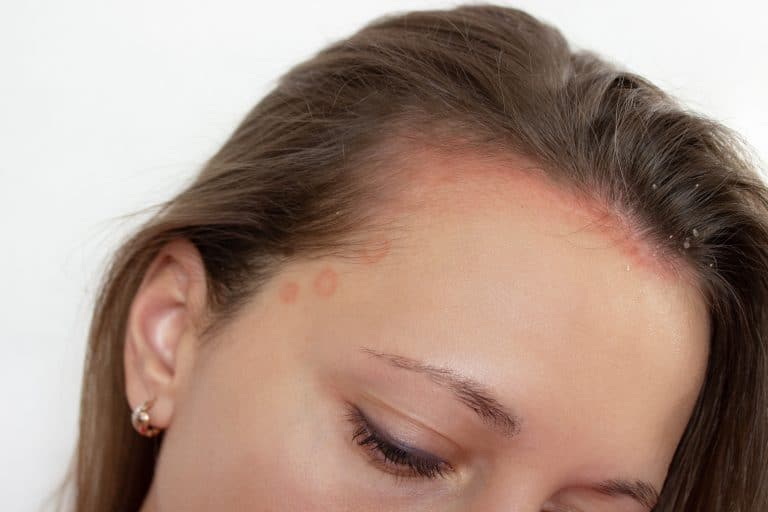 seborrheic dermatitis shampoo, ​scalp healer, scalp treatment, hair scalp care, itchy scalp relief, scalp repair cream, ​sebhorrheic dermatitis treatment, scalp care, antifungal shampoos, moisturizing creams, skin care routines, natural remedies, Shampoo for Scalp Psoriasis,