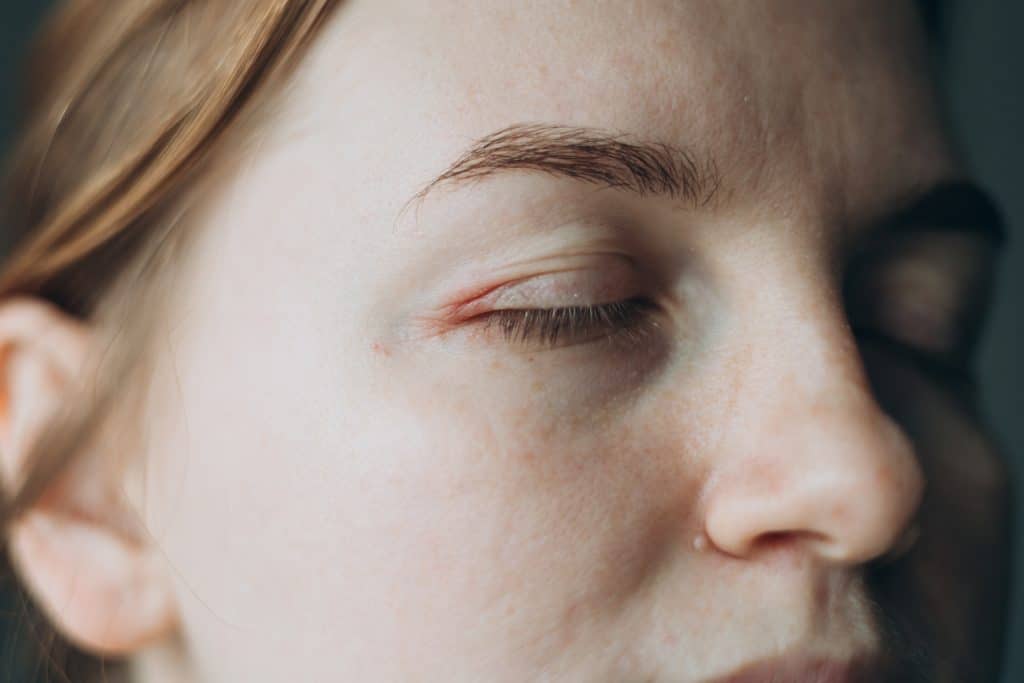 eyelid eczema, eyelid dermatitis, eczema treatment Ireland, itchy eyelids remedy, sensitive skin care Ireland