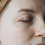 eyelid eczema, eyelid dermatitis, eczema treatment Ireland, itchy eyelids remedy, sensitive skin care Ireland