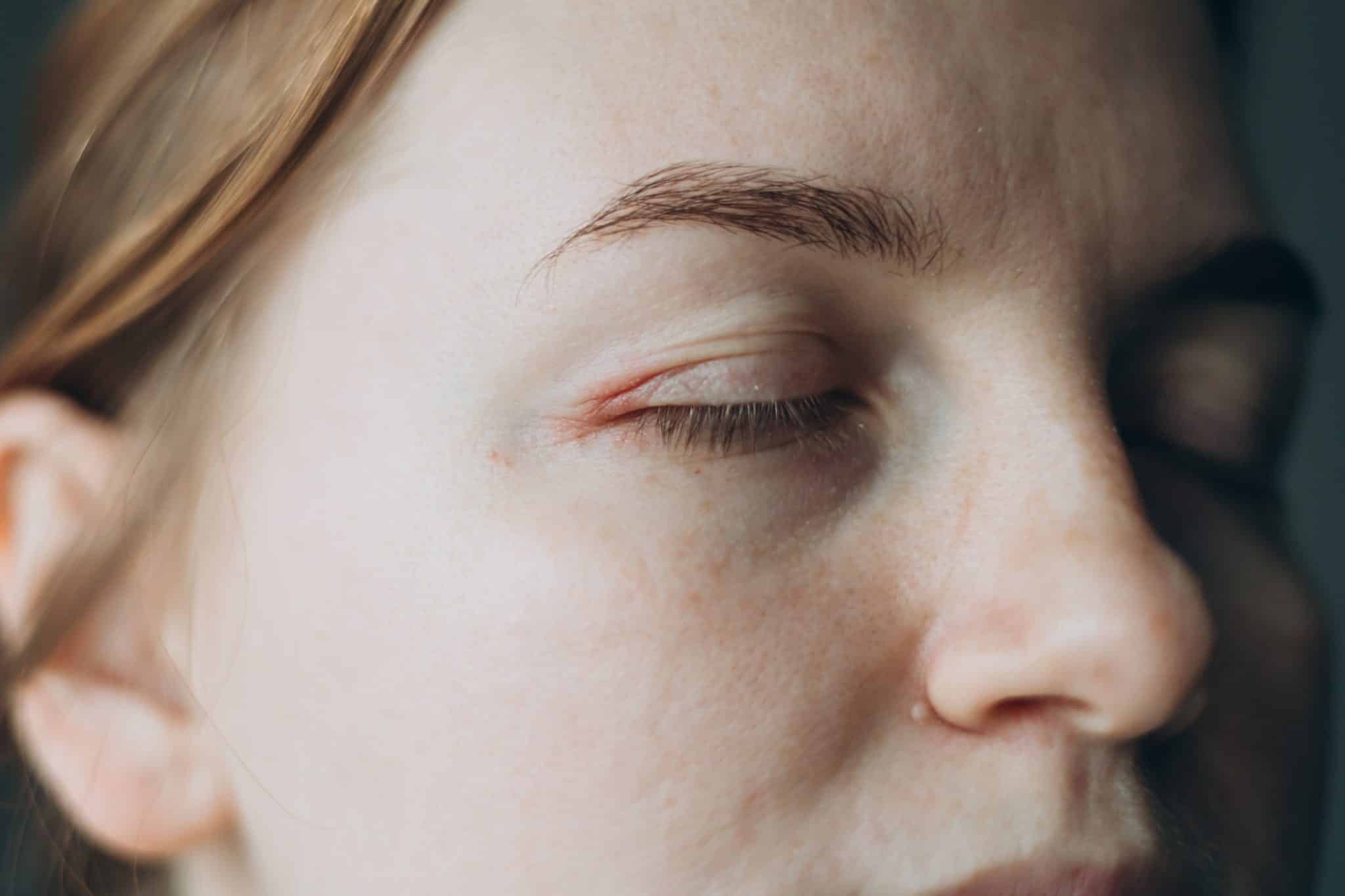 ​eyelid eczema, eyelid dermatitis, eczema treatment Ireland, itchy eyelids remedy, sensitive skin care Ireland