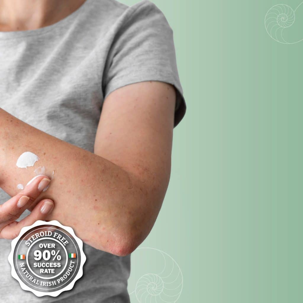 Photo of a man applying a natural eczema cream