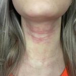 Girl with eczema on her neck