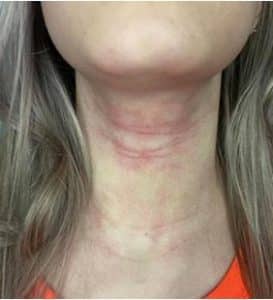 Girl with eczema on her neck