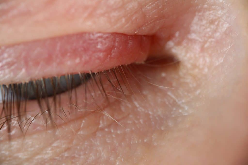 eyelid eczema, eczema around eyes, eyelid rash treatment, dry eyelid skin, sensitive skin on eyelids, soothe eyelid eczema, eyelid rash, eczema around eyes, eye dermatitis, eyelid itching,