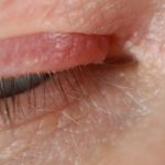 soothe eyelid eczema, eyelid rash, eczema around eyes, eye dermatitis, eyelid itching,