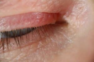 ​soothe eyelid eczema, eyelid rash, eczema around eyes, eye dermatitis, eyelid itching,