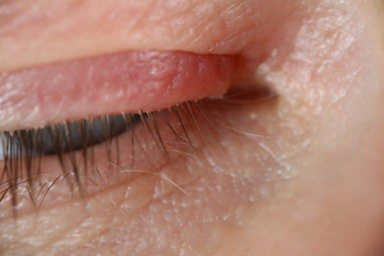 ​soothe eyelid eczema, eyelid rash, eczema around eyes, eye dermatitis, eyelid itching,