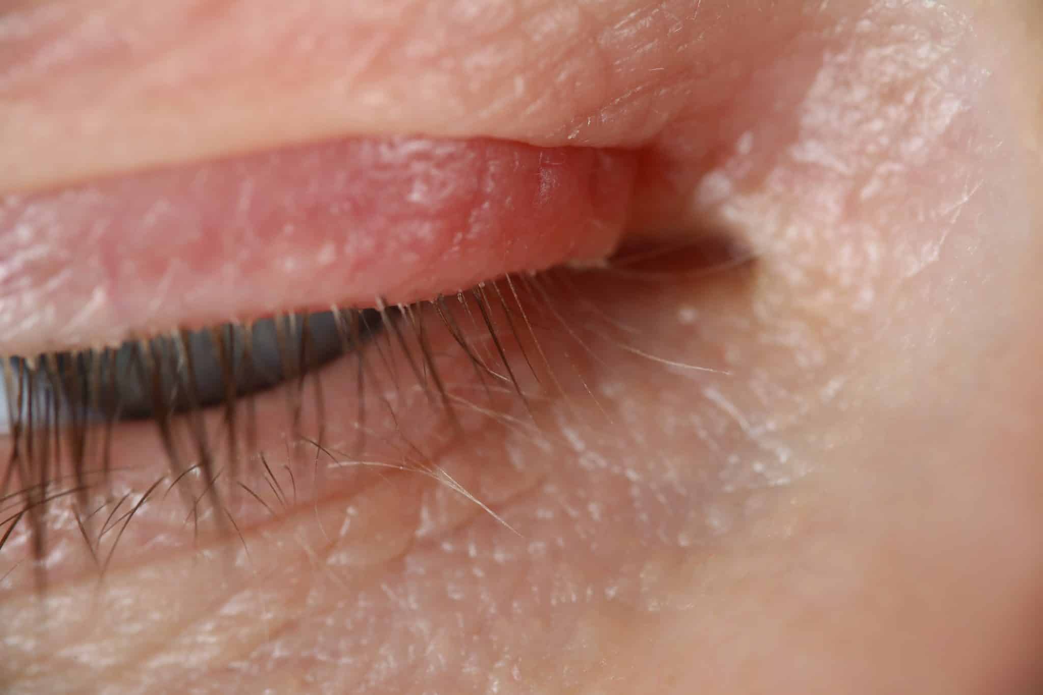 soothe eyelid eczema, eyelid rash, eczema around eyes, eye dermatitis, eyelid itching,