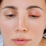 Can Eczema Cause Eyelids to Swell, eczema eyelid swelling, eyelid rash causes, treating eyelid eczema, eyelid inflammation Ireland