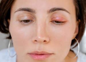Can Eczema Cause Eyelids to Swell, eczema eyelid swelling, eyelid rash causes, treating eyelid eczema, eyelid inflammation Ireland