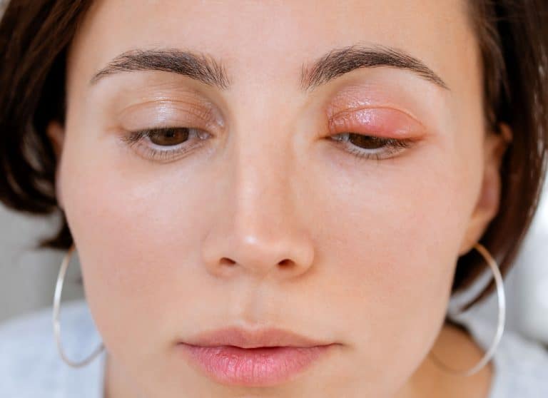 Can Eczema Cause Eyelids to Swell, eczema eyelid swelling, eyelid rash causes, treating eyelid eczema, eyelid inflammation Ireland