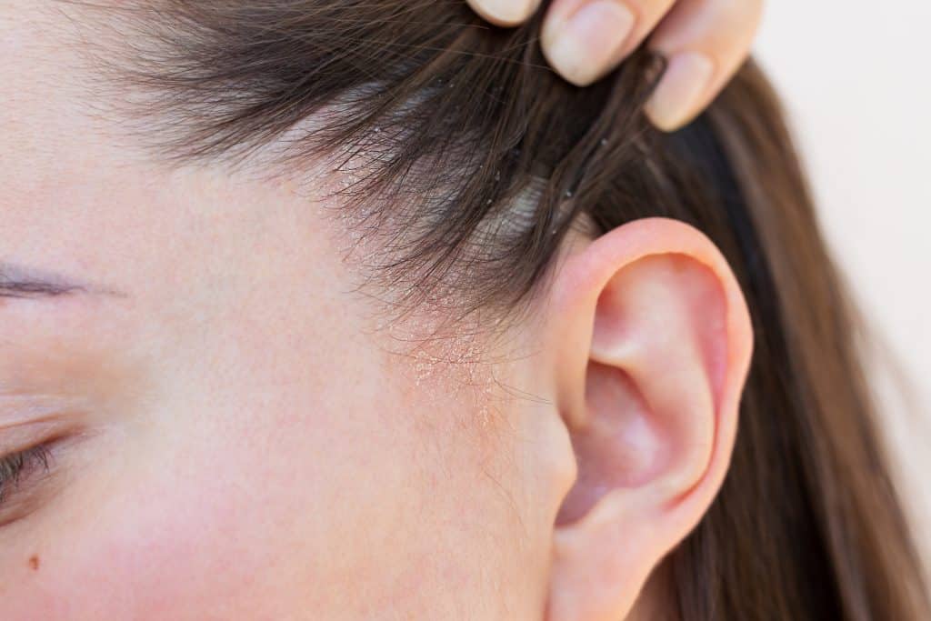 ​Natural treatment for seborrheic dermatitis, home remedies for seborrheic dermatitis, natural oils for seborrheic dermatitis, herbal treatments for seborrheic dermatitis, seborrheic dermatitis care at home