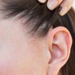 ​Natural treatment for seborrheic dermatitis, home remedies for seborrheic dermatitis, natural oils for seborrheic dermatitis, herbal treatments for seborrheic dermatitis, seborrheic dermatitis care at home