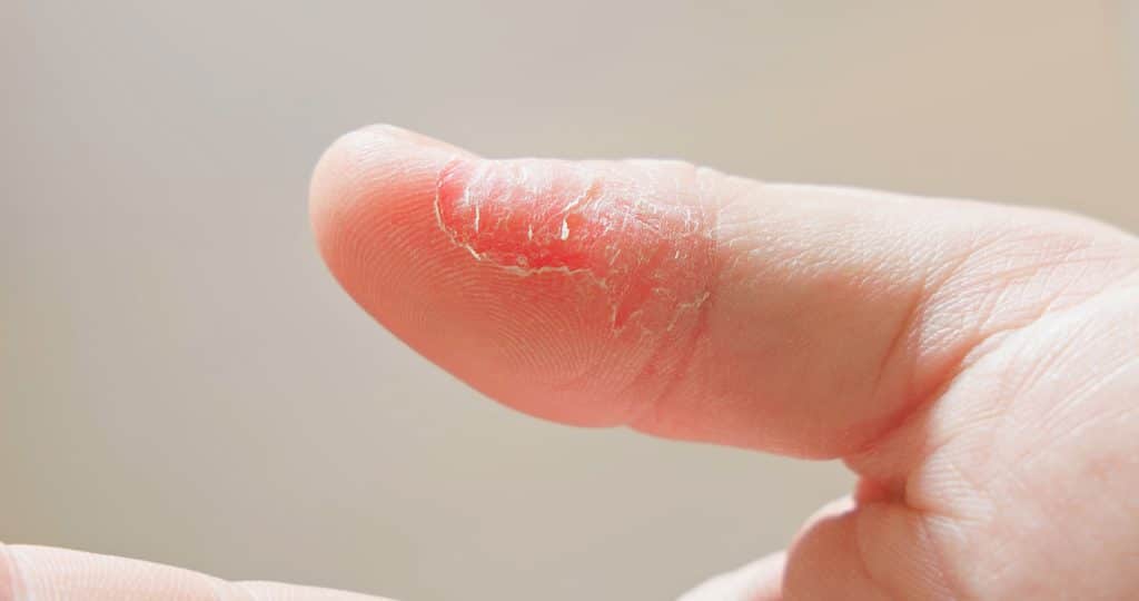 Types of eczema