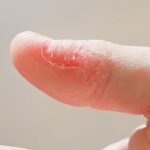 Dyshidrotic eczema