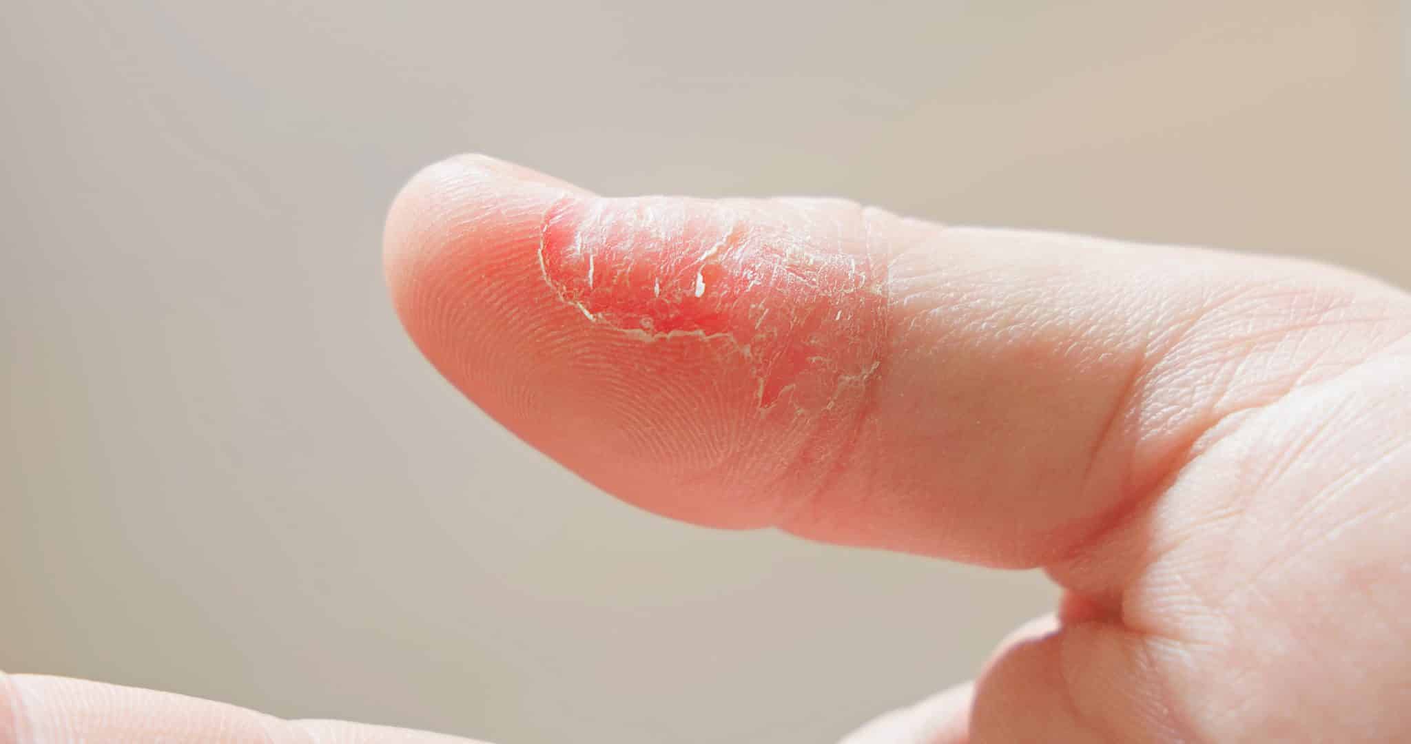 Dyshidrotic eczema
